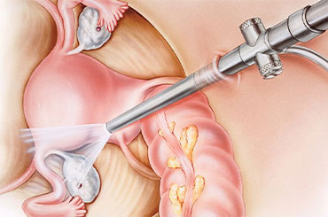 laparoscopy and hysteroscopy pregnancy treatment in Anand