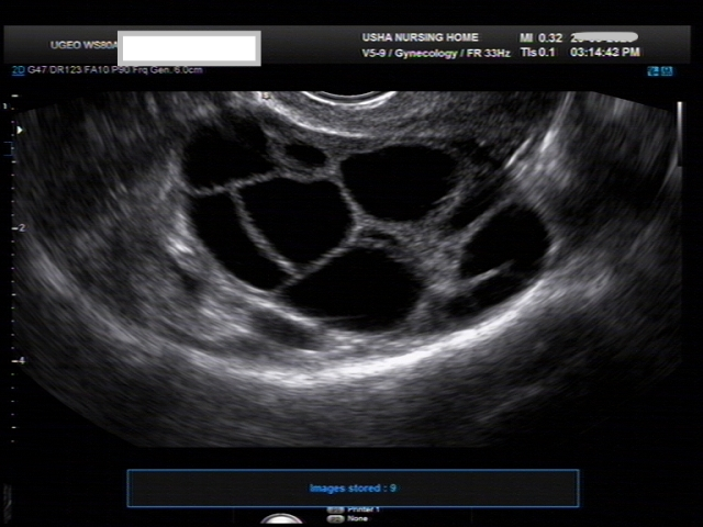 Ultrasound Procedure in Anandnbsp