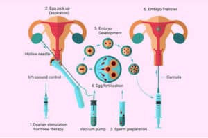 IVF is the One of Oldest IVF Treatment Center in Indianbsp