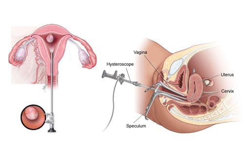Laparoscopy Hysteroscopy for infertility Purpose Procedure and Cost Indianbsp