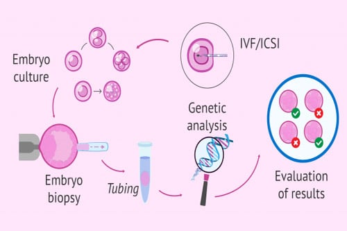Preimplantation genetic diagnosis in vitro fertilization (IVF)