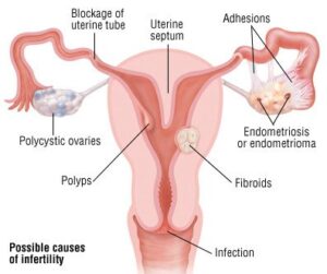 Female Infertility Associated Symptoms in India