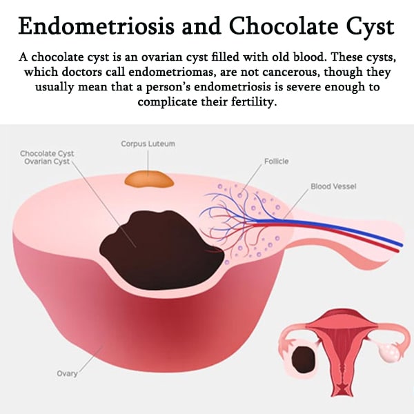 Endometriosis and Chocolate Cystnbsp