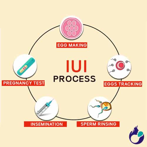 Intrauterine Insemination (IUI) Process By Usha Thakkar