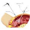 3D Laprsocopic Surgery Hysterectomy in Usha IVFnbsp