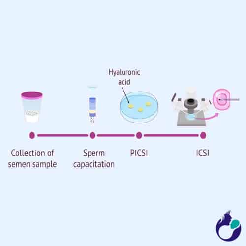 Sperm Selection for IVF | ICSI, PICSI Procedure Technique in Anand