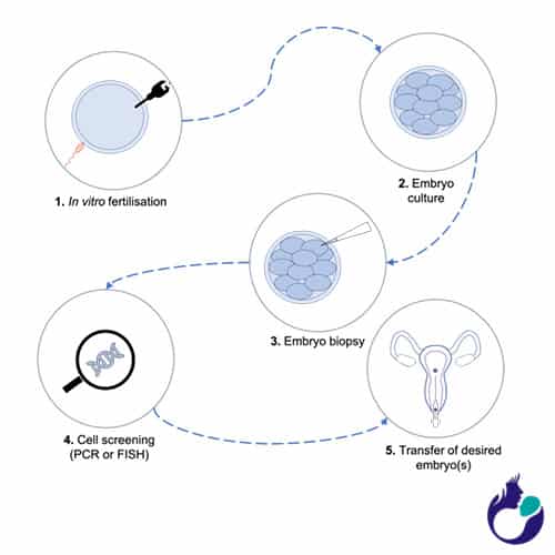 Pre Implantation Genetic Diagnosis Process in Usha IVF
