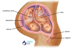 24 weeks pregnant with twins Symptoms and fetal development Usha IVF