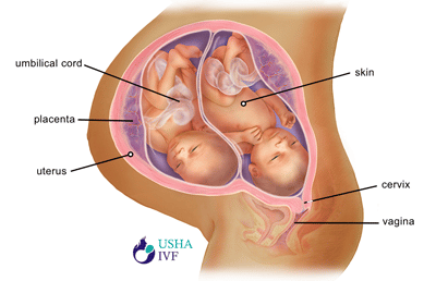 24 weeks pregnant with twins, Symptoms and fetal development- Usha IVF