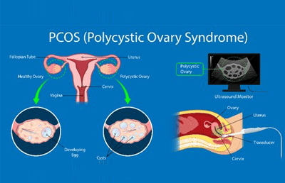 Best Treatment for PCOS or PCODnbsp