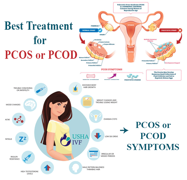 Best treatment for PCOS or PCOD