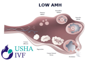 Low AMH IVF Treatment in Anandnbsp