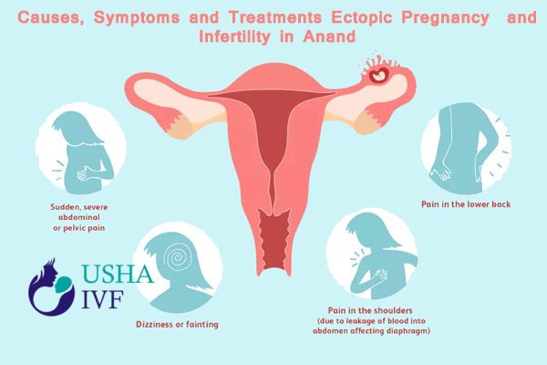 Ectopic pregnancy and Infertility in anandnbsp