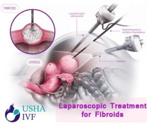Laparoscopic Treatment for Fibroidsnbsp