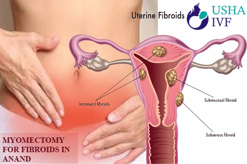 Myomectomy for Fibroids in Anand | Myomectomy removal of uterine fibroids