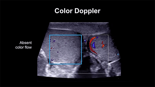 Ultrasound in Scrotal Doppler
