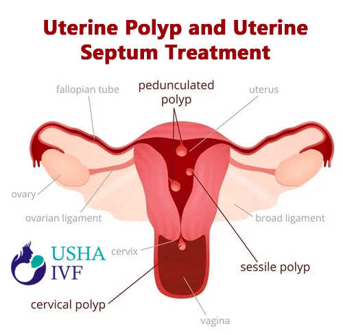 Uterine Polyp and Uterine Septum Treatmentnbsp
