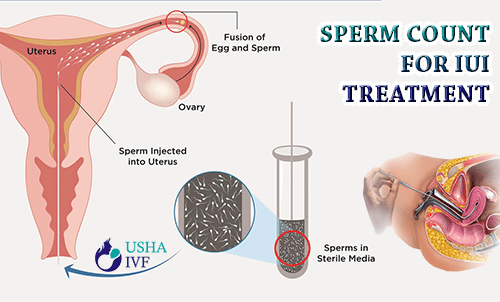 sperm count for iui treatmentnbsp
