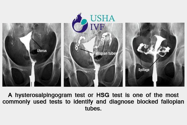 Tubal testing by HSG