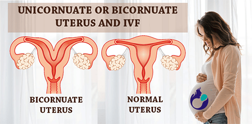 unicornuate or bicornuate uterus and ivfnbsp
