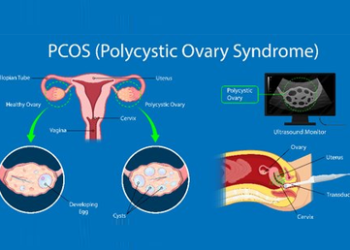 Best Treatment for PCOS or PCOD