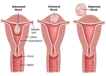 Fibroid & Infertility