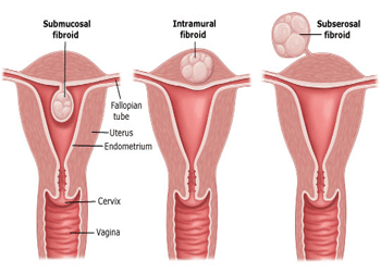 Fibroid & Infertility