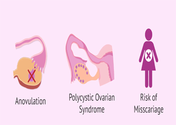 Obesity and Infertility