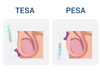 TESA or PESA Treatment