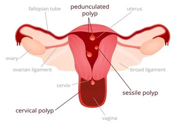 Uterine polyp and uterine septum treatment